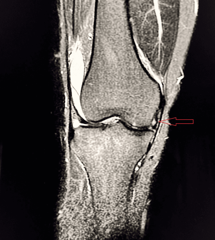 MRI of a grade-one medial collateral ligament sprain, an arrow at the level of the joint line