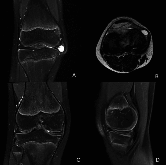 Four-panel knee MRI of a parameniscal cyst, a bright well-defined collection at the joint line