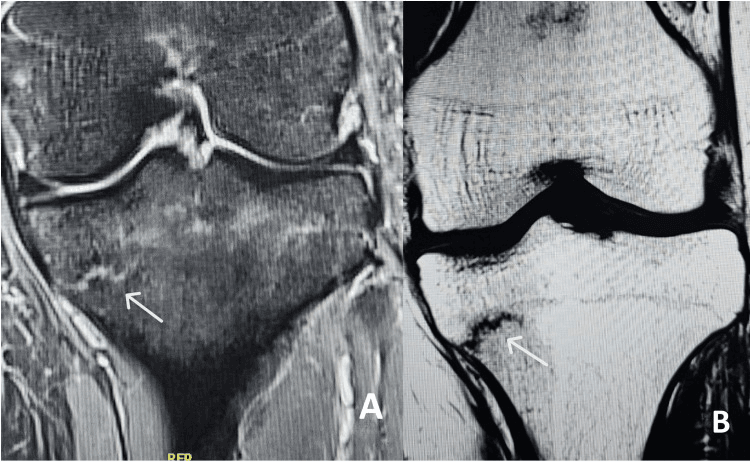Two-panel MRI of a proximal tibial stress fracture, arrows marking the abnormality beneath the tibial plateau