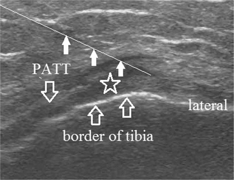 Ultrasound-guided injection: the needle path, marked by solid arrows, runs towards a star beneath the structure labelled PATT and above the border of the tibia
