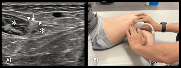 Two panels: ultrasound of sartorius and the infrapatellar branch of the saphenous nerve annotated with asterisks, an arrow and arrowheads, and the ultrasound probe position
