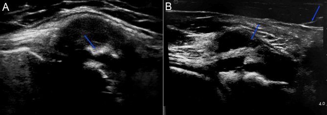 Two-panel ultrasound of the semimembranosus-MCL bursa with blue line markers