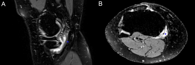 Two-panel MRI of the semimembranosus-medial collateral ligament bursa, an asterisk marking the bursa in each