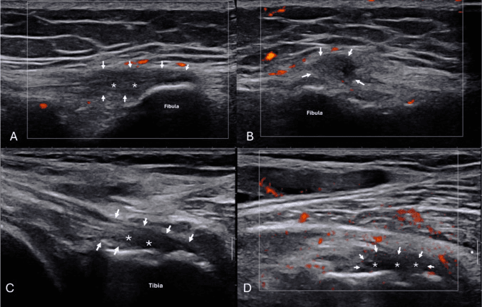 Four-panel ultrasound of hypoechoic soft-tissue lesions marked with asterisks and outlined by arrows, panels labelled over the fibula and the tibia