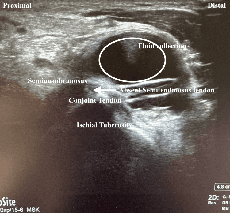 Ultrasound labelled proximal to distal at the ischial tuberosity, showing an absent semitendinosus tendon beside the conjoint tendon and semimembranosus, with a circled fluid collection