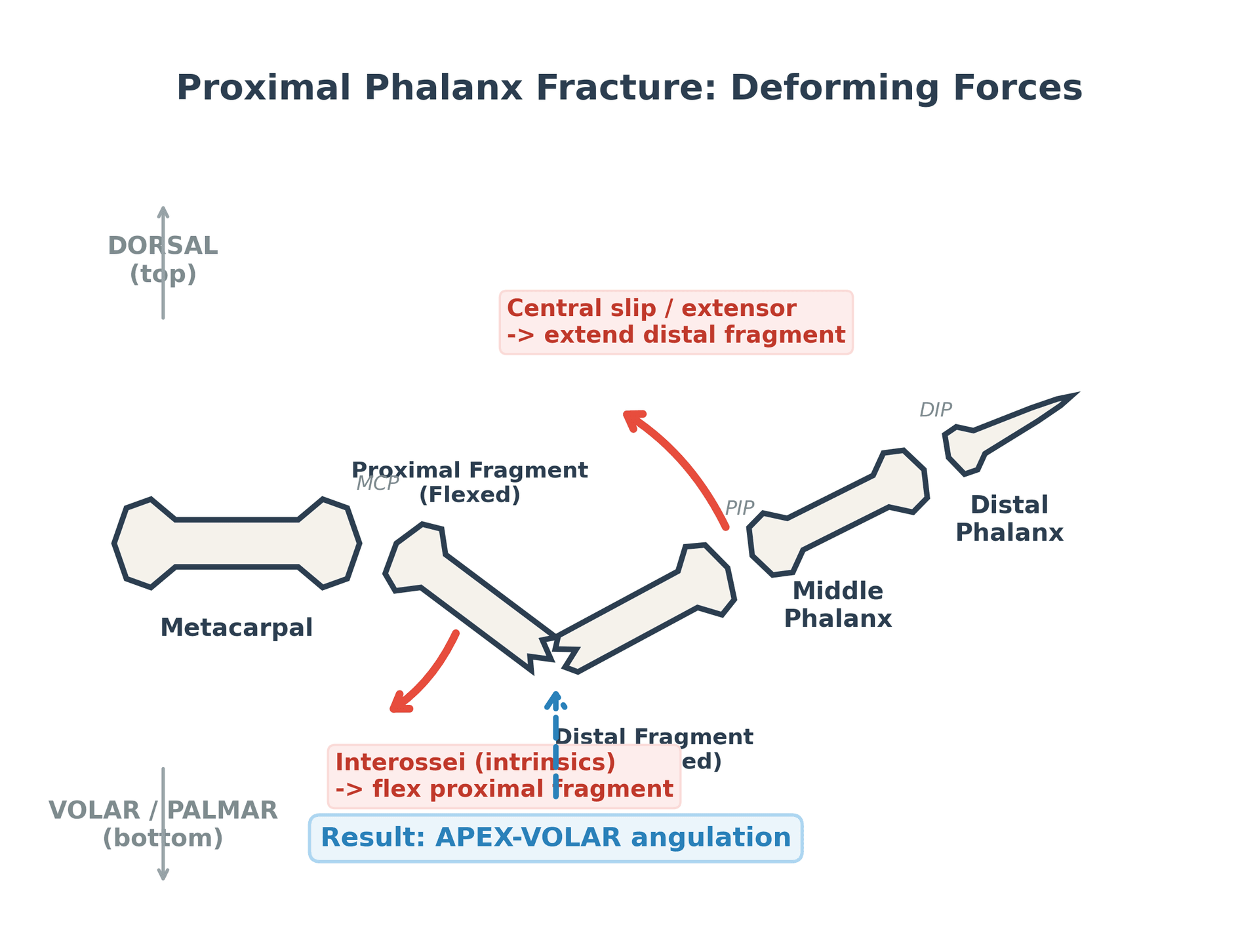 Lateral diagram of proximal phalanx fracture deforming forces producing apex-volar angulation