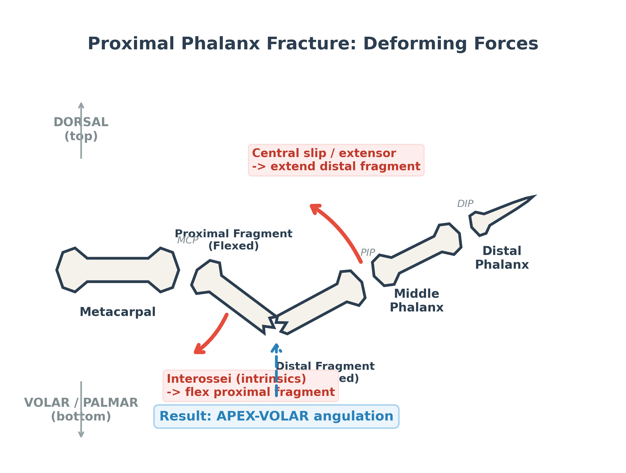 Lateral diagram of proximal phalanx fracture deforming forces producing apex-volar angulation