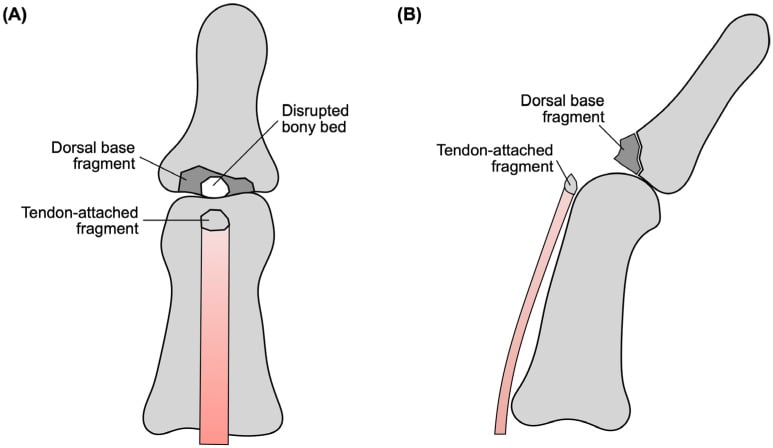 Schematic of a double-level mallet lesion with tendon-attached and dorsal base fragments