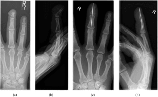 Radiographs of a displaced distal phalanx fracture before and after K-wire fixation