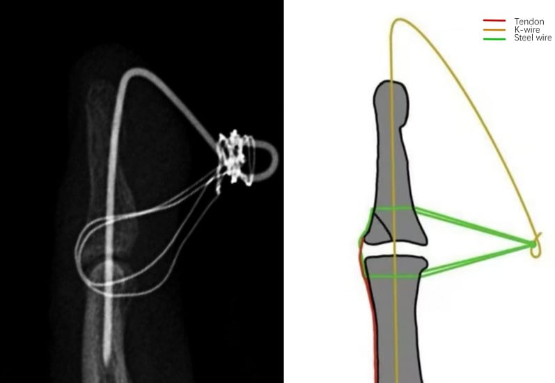 Radiograph and diagram of correct K-wire placement with tension-band geometry