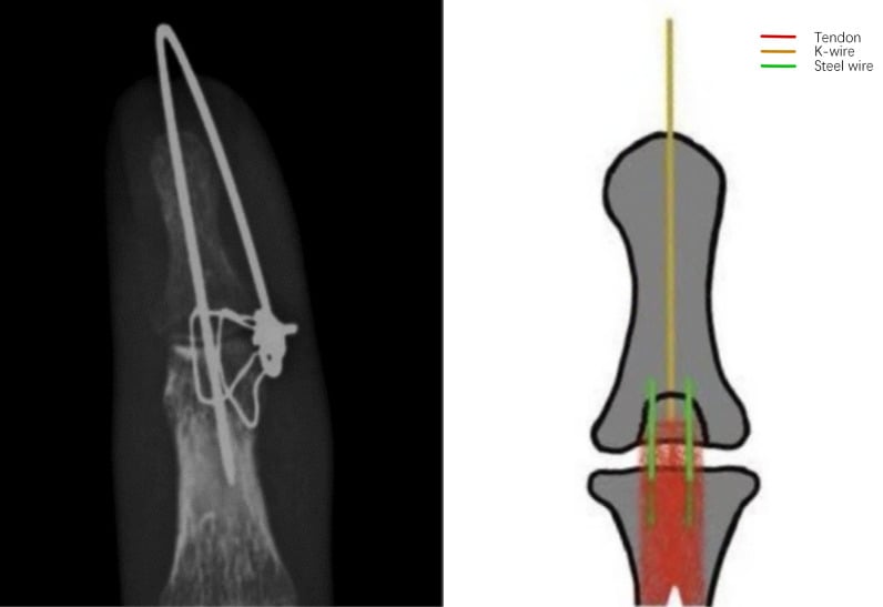 Radiograph and diagram of correct wire and K-wire placement