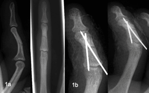 Radiographs after injury and after osteosynthesis of a phalanx fracture