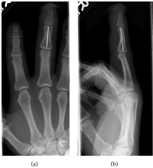 Radiograph showing a retained Kirschner wire in a finger phalanx