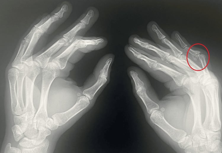 Lateral radiographs of both hands with the proximal interphalangeal joint circled