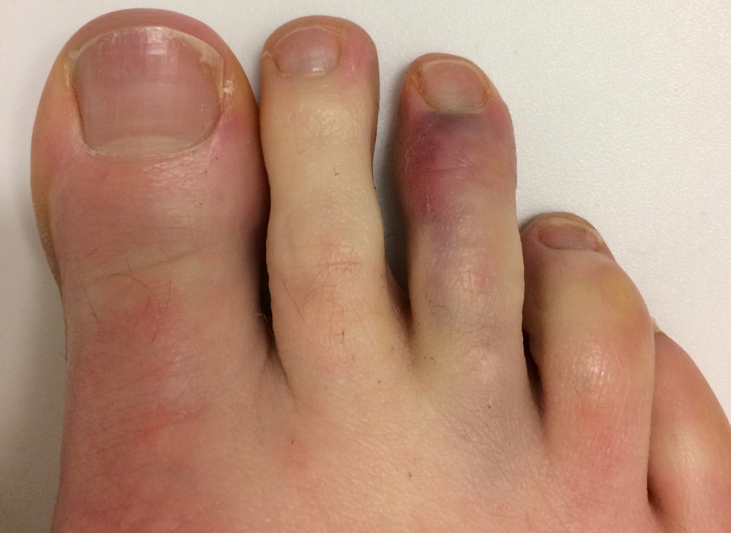 Clinical photograph of a foot showing a bruised, swollen toe consistent with a phalangeal fracture.