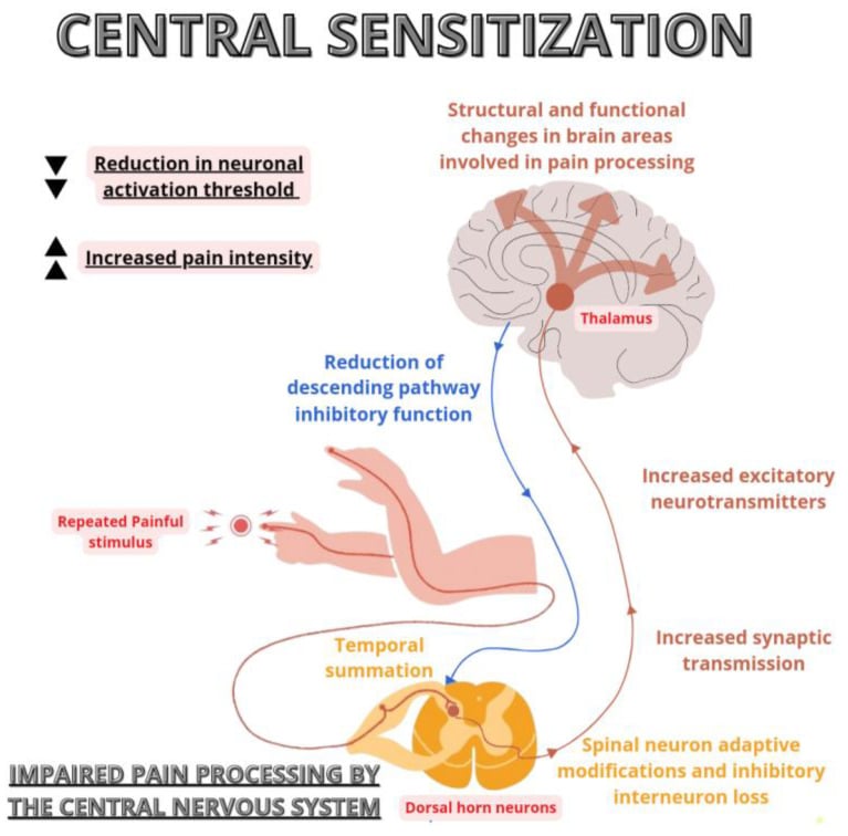 Schematic of central sensitisation showing reduced neuronal activation threshold, temporal summation, increased excitatory neurotransmitters, loss of inhibitory interneurons and impaired descending inhibition
