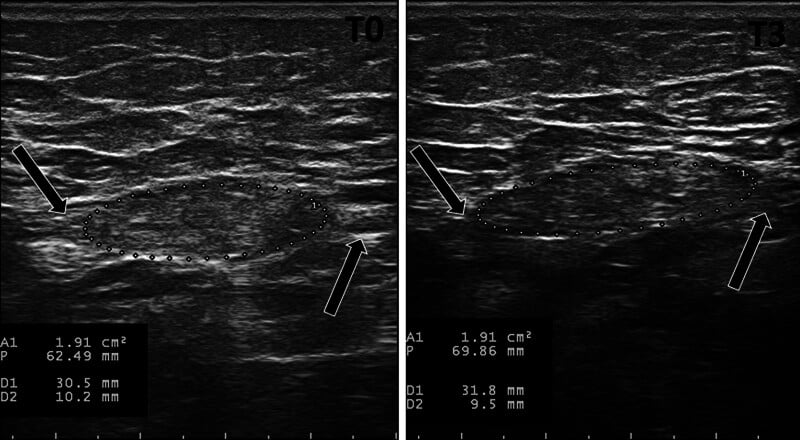 Longitudinal ultrasound of a symptomatic neuroma in a transfemoral residual limb with cross-sectional area measured before treatment and at three months