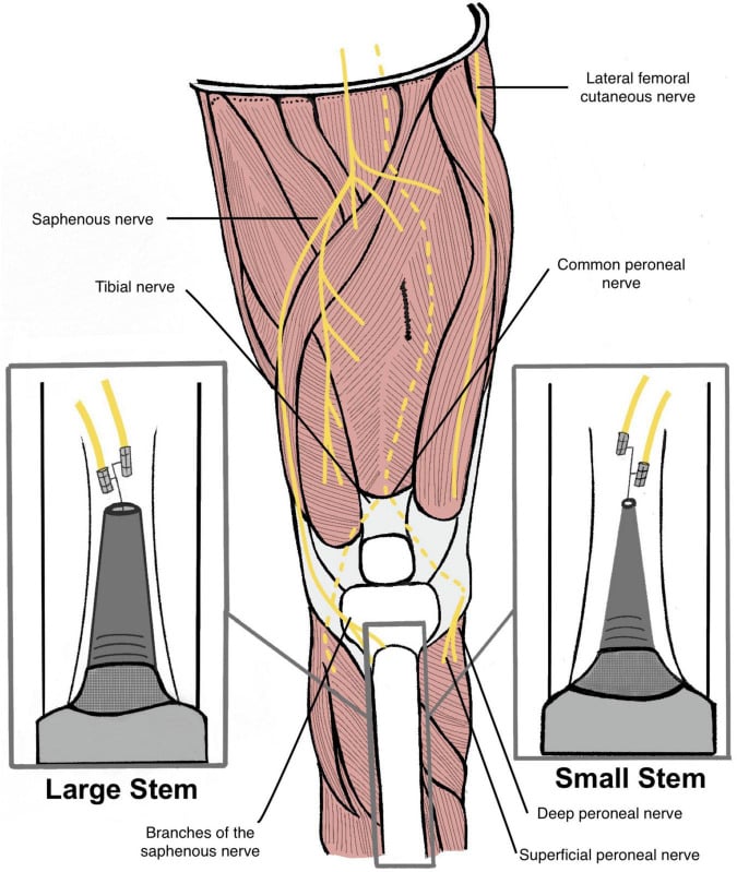 Illustration of a transtibial residual limb showing the saphenous, tibial, common peroneal and lateral femoral cutaneous nerves in relation to prosthetic stems of differing diameter