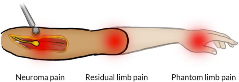 Illustration of a residual upper limb distinguishing neuroma pain at the cut nerve end, residual limb pain and phantom limb pain felt in the absent hand