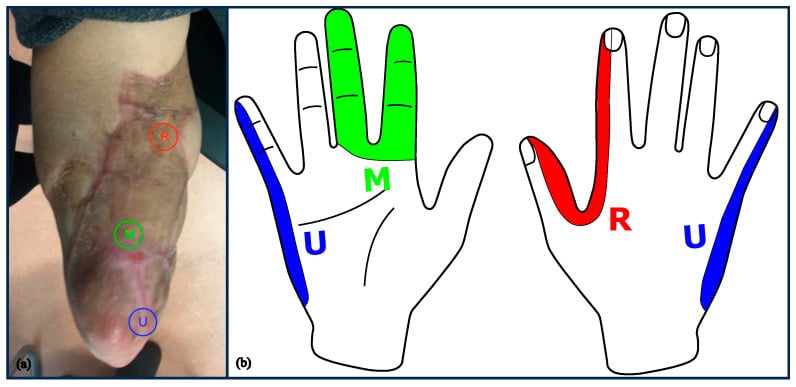 Residual limb with Hoffmann-Tinel sign locations marked alongside a hand diagram showing the median, radial and ulnar territories to which percussion refers phantom sensation