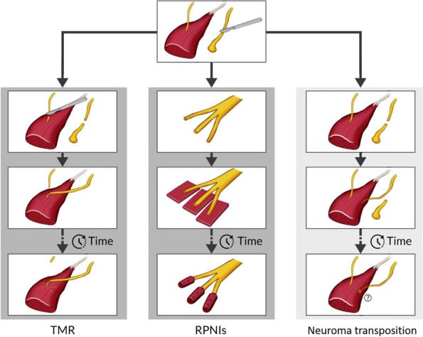 Schematic comparing targeted muscle reinnervation, regenerative peripheral nerve interfaces and neuroma transposition, each shown at the point of surgery and after time has elapsed