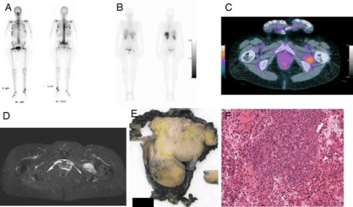 Whole-body bone scan with multiple focal hot spots and generally increased skeletal uptake.