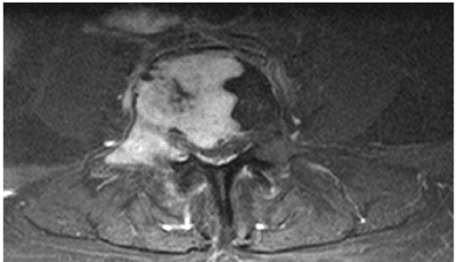 Axial enhanced T1-weighted lumbar MRI with a well-defined enhancing lesion in a vertebral body.