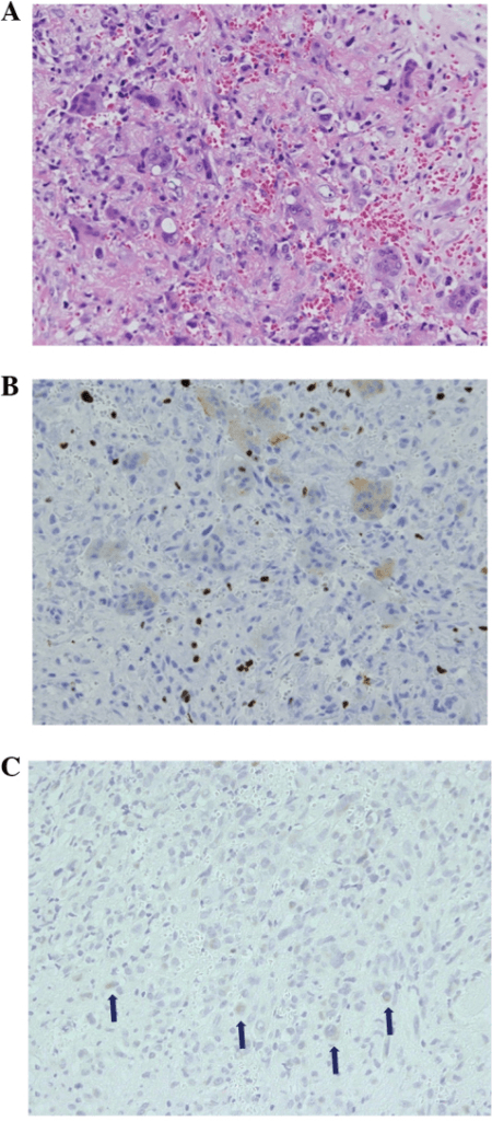 Haematoxylin and eosin stained section with spindle and round cells, multinucleated giant cells and capillaries.