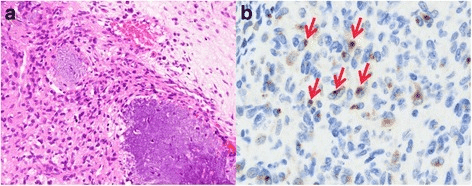 Paired histology images: bland spindle cells with grungy calcification and dot-like immunostaining.
