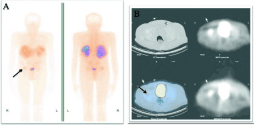 SPECT/CT of pelvis showing focal uptake in right femoral head with matching sclerotic lesion on CT.