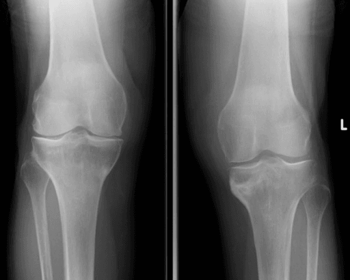 AP radiographs of both proximal tibias showing sclerosis and periosteal reaction medially.