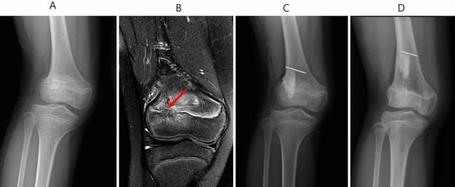 Bar Resection Physeal Injuries (Salter-Harris Classification) | OrthoVellum