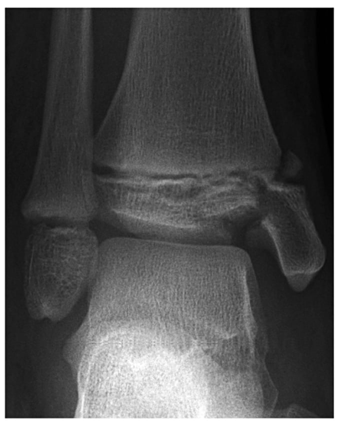 AP ankle radiograph showing a comminuted Salter-Harris type III distal tibia fracture with a depressed articular die-punch fragment