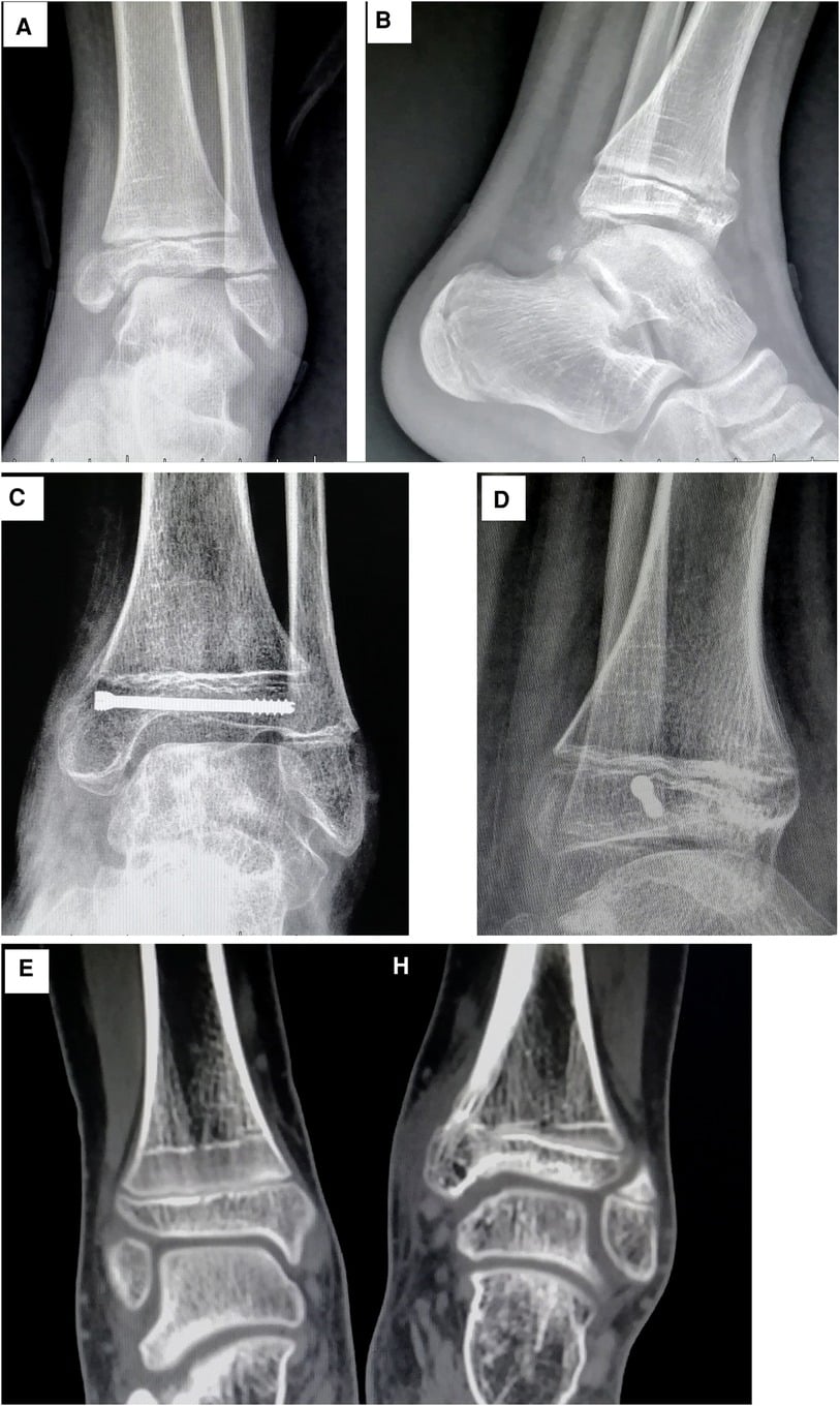 Serial radiographs and CT of a Salter-Harris type IV distal tibial fracture showing formation of a growth arrest line and medial bone bridge