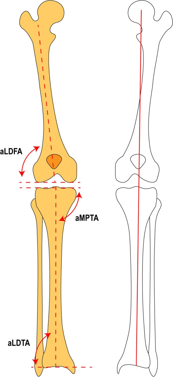 Long-leg alignment schematic showing mechanical axis and aLDFA, aMPTA and aLDTA measurements