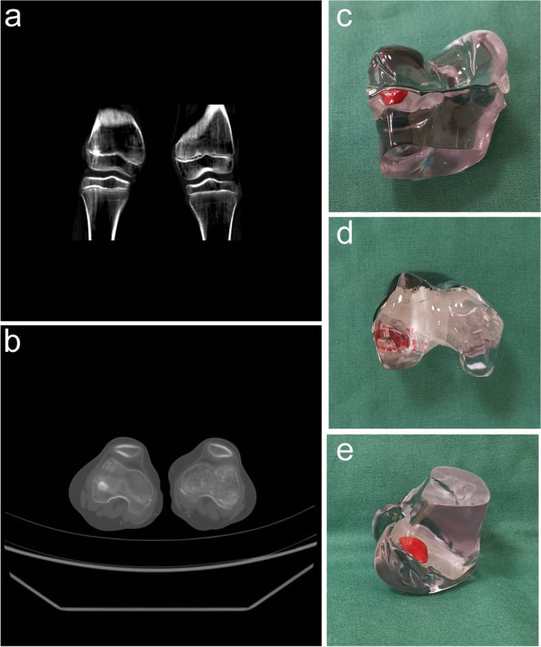 Coronal and axial CT with a transparent three-dimensional distal femoral model highlighting a focal physeal bar