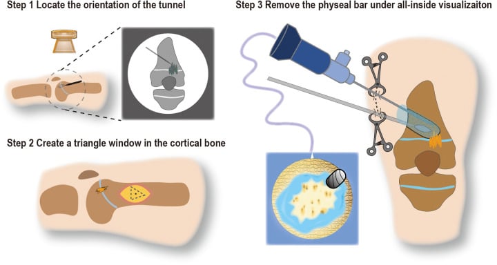 Schematic showing cortical-window creation and tunnel-guided endoscopic excision of a central physeal bar