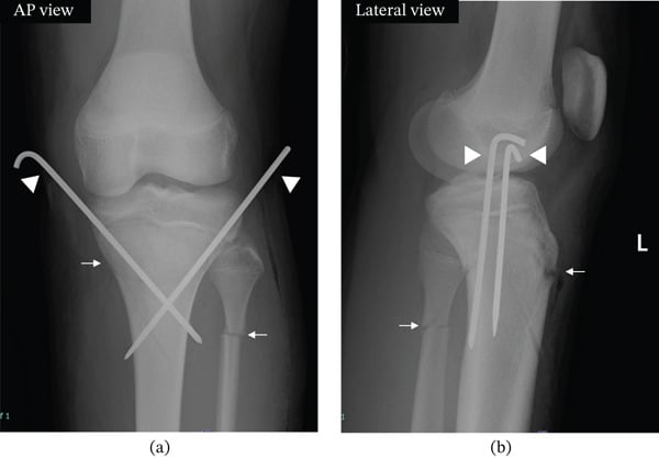 AP and lateral knee radiographs showing reduction of a proximal tibial physeal fracture with crossed smooth K-wires