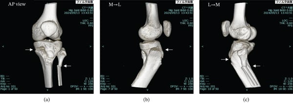 Three-dimensional CT views showing a Salter-Harris type II proximal tibial fracture with an associated proximal fibular fracture