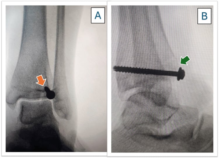 AP and lateral ankle radiographs showing epiphyseal cannulated-screw fixation of a Tillaux fracture