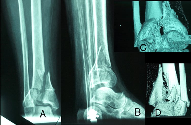 Radiographs and three-dimensional CT of a severe pilon fracture