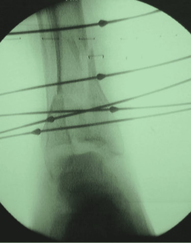 Ilizarov wire reconstruction of a severely comminuted pilon fracture