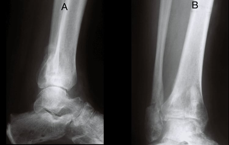 Follow-up radiographs after Ilizarov treatment of a severe pilon fracture