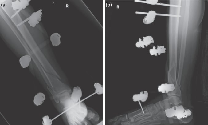 AP and lateral radiographs after ankle-spanning external fixation