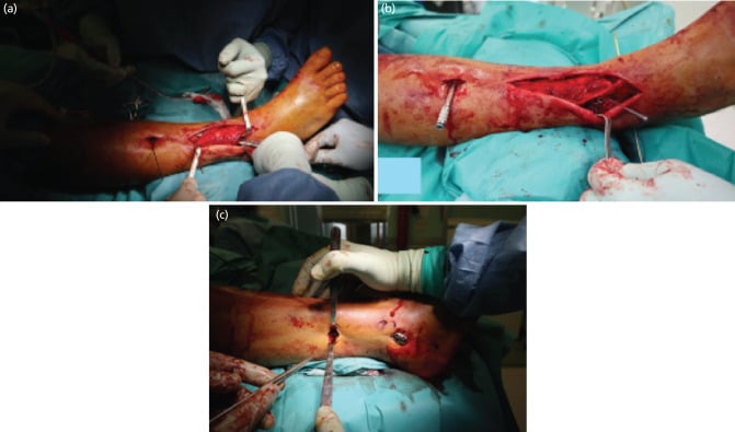 Anterolateral pilon approach with superficial peroneal nerve identification