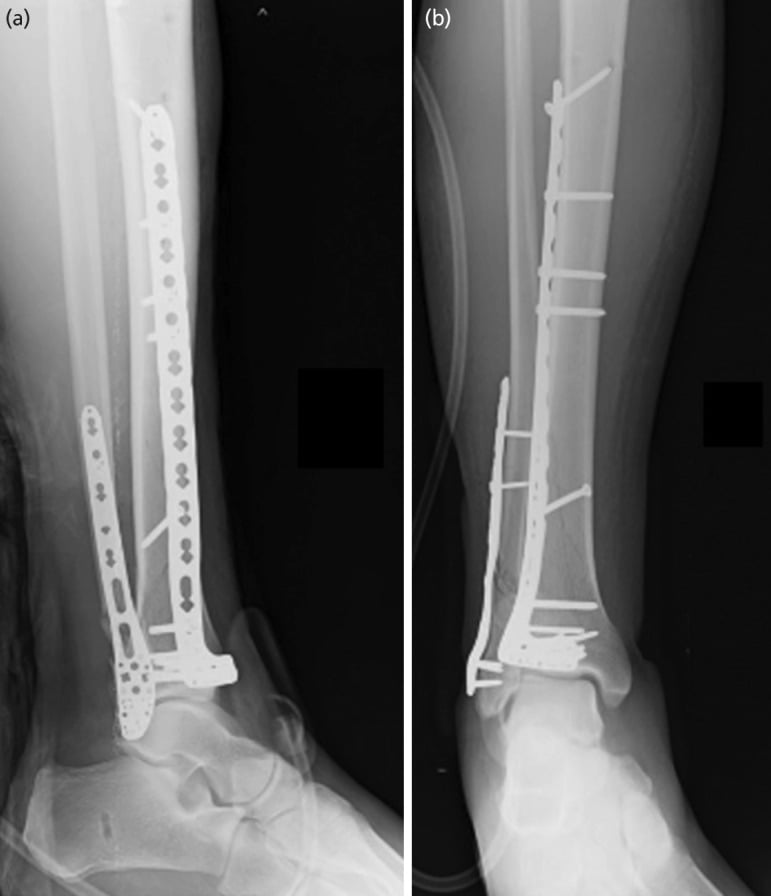 AP and lateral radiographs after definitive pilon ORIF