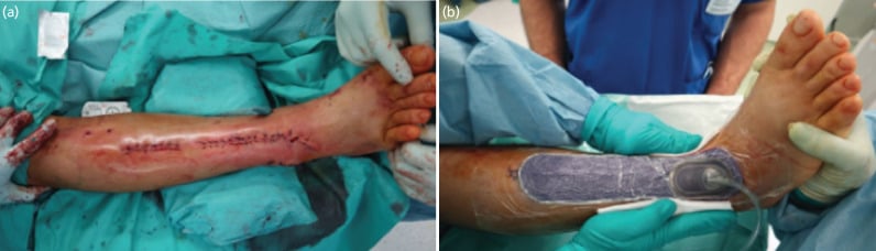 Closed anterolateral incision with negative-pressure dressing