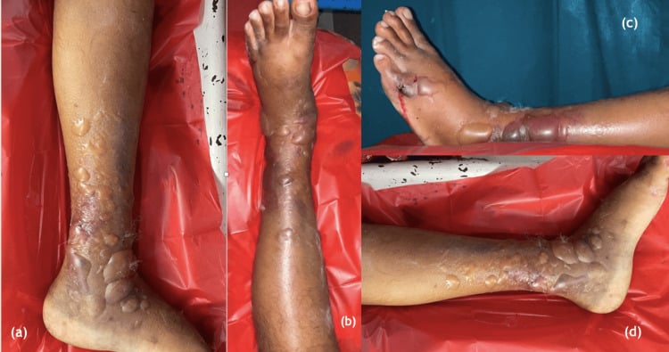 Fracture blisters around a swollen pilon fracture
