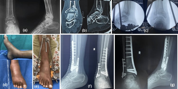 Radiographs CT swelling and staged fixation of a pilon fracture