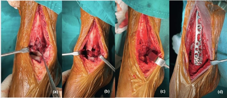 Elevation and bone grafting of an impacted tibial plafond